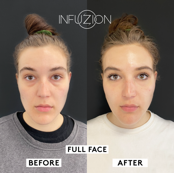 Infuzion_Volymizer_Before_After_Eya