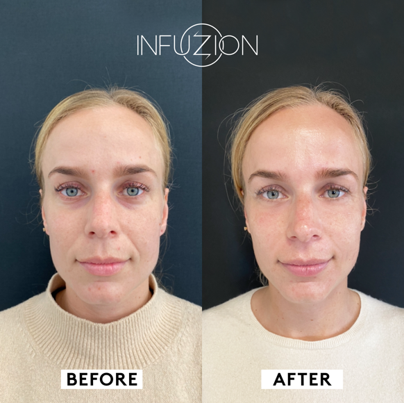 Infuzion_Volymizer_Before_After_Hannah