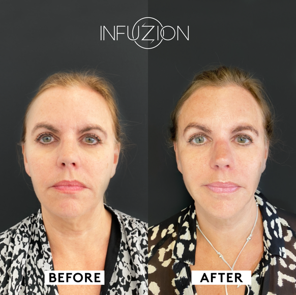 Infuzion_Volymizer_Before_After_Helena