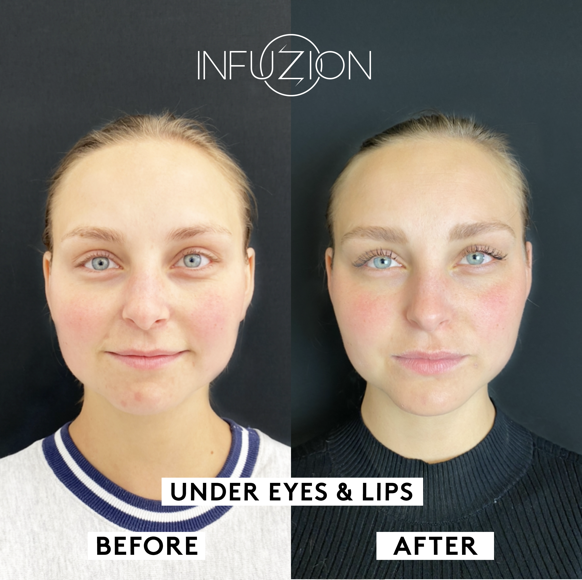 Infuzion_Volymizer_Before_After_Madeleine